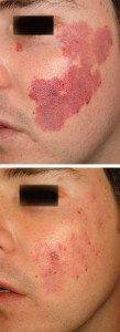 Birthmarks before and after 12