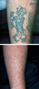 Tattoo Laser Removal 9