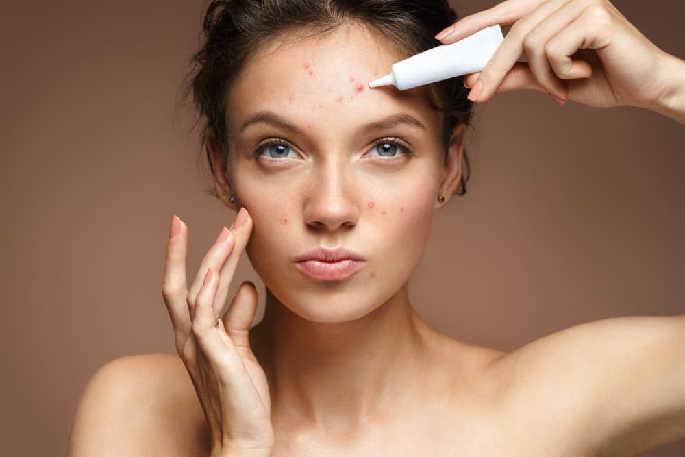 Acne: Causes, Treatments, and Prevention